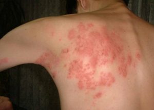 Shingles: What Health Workers Need To Know