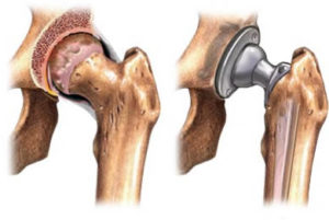 Hip Replacement Surgery in India