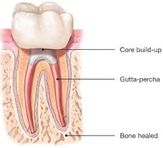 Best Root Canal Treatment in India