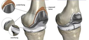 Knee Joint Replacement Surgery