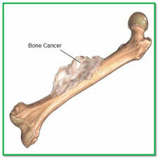 Bone Cancer – Types, Causes, Symptoms and Treatment