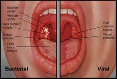 Get Rid of Sore Throat